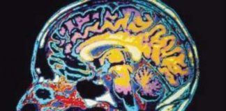 La nabilona mejora la agitación y otros síntomas conductuales en pacientes con enfermedad de Alzheimer