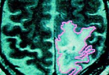 El descubrimiento del cannabinoide cannabielsoxa pone de relieve el coste humano y científico de la prohibición del cannabis brain cancer cannabis