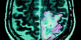 brain cancer cannabis