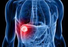 Cáncer y marihuana, qué deben saber los pacientes Cáncer y marihuana, qué deben saber los pacientes