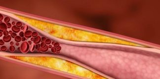 El consumo de cannabis no aumenta el riesgo de aterosclerosis