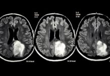 El CBD puede tener un efecto positivo sobre la supervivencia en el glioblastoma según un estudio abierto El CBD puede tener un efecto positivo sobre la supervivencia en el glioblastoma según un estudio abierto