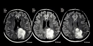 El CBD puede tener un efecto positivo sobre la supervivencia en el glioblastoma según un estudio abierto