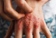 El cannabis puede ser útil en el prurito según un informe del caso Man scratch oneself, dry flaky skin on hand with psoriasis vulgaris, eczema and other skin conditions like fungus, plaque, rash and patches. Autoimmune genetic disease.
