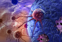 El CBD puede reducir los síntomas de la neuropatía periférica inducida por la quimioterapia cancer cell