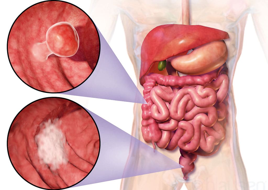 Úlceras, abscesos y fístulas son frecuentes en la enfermedad de Crohn